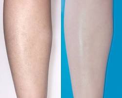 Laser Hair Removal before after 2