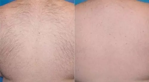 Laser Hair Removal before after 3