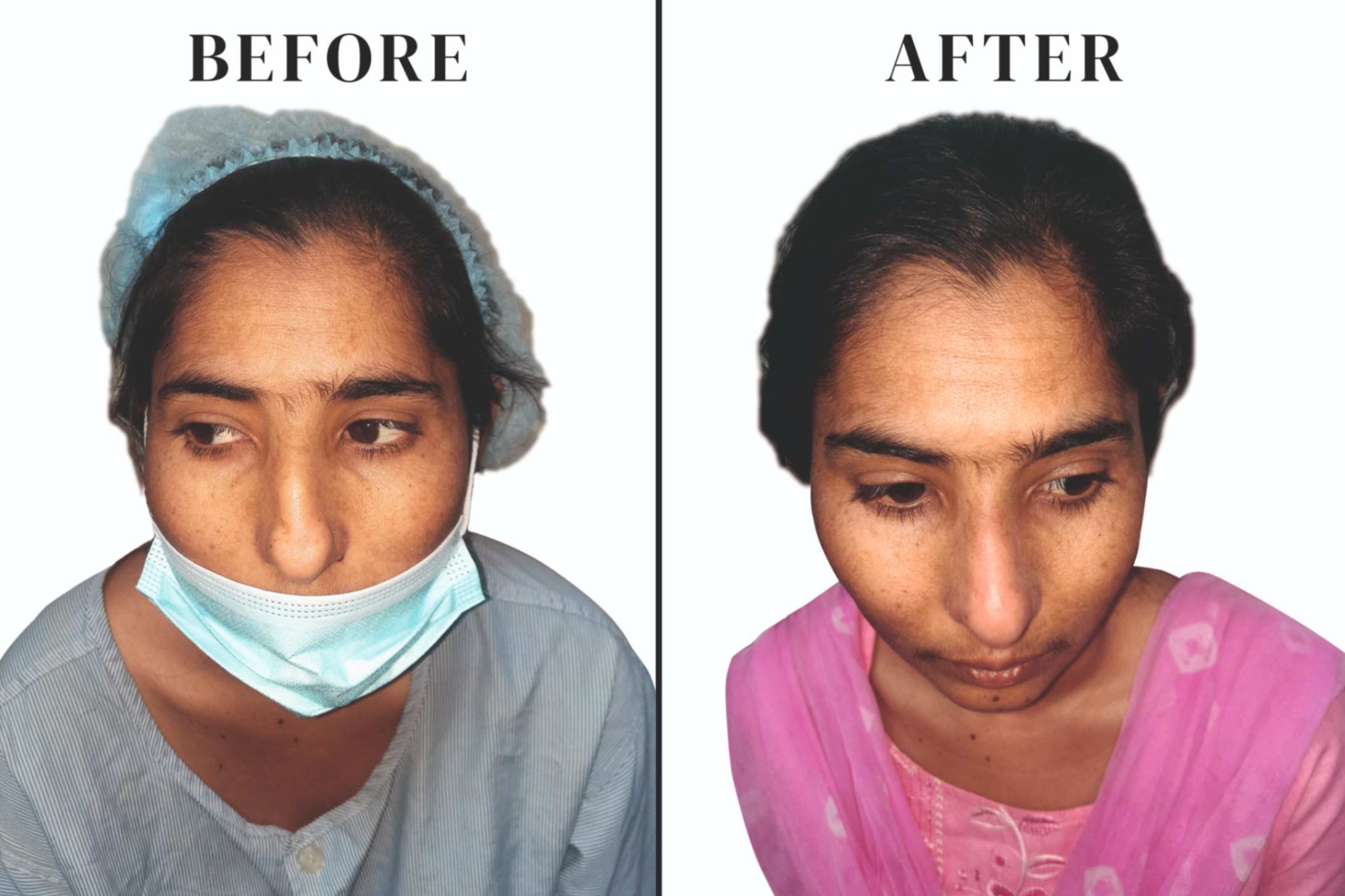 Rhinoplasty drabhimanyusingh 02