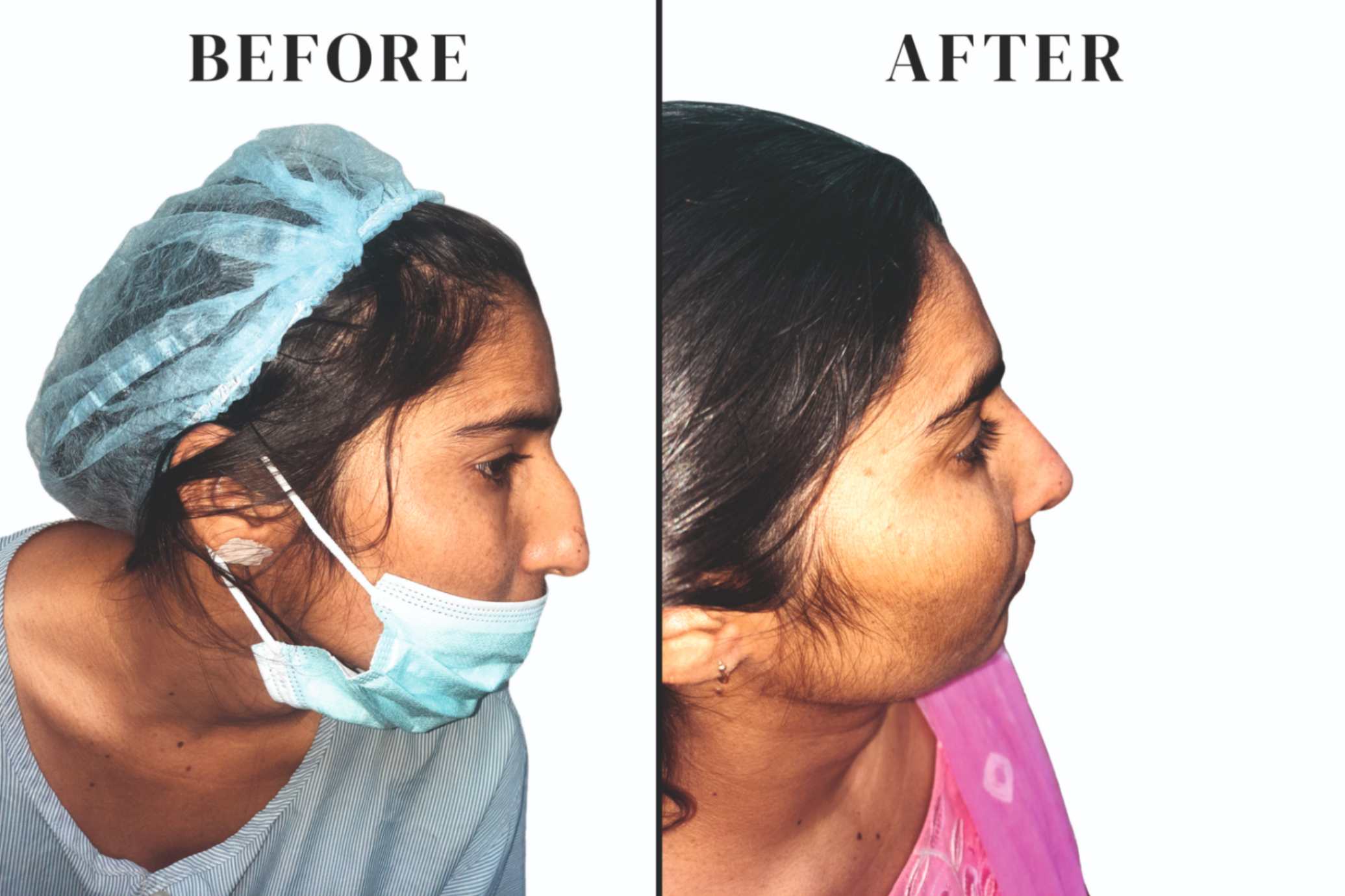 Rhinoplasty drabhimanyusingh 03