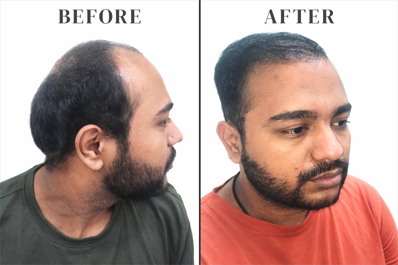 before after hair transplant