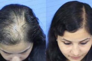 Hair Transplant (Before - After)