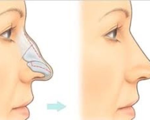Dorsal hump reduction