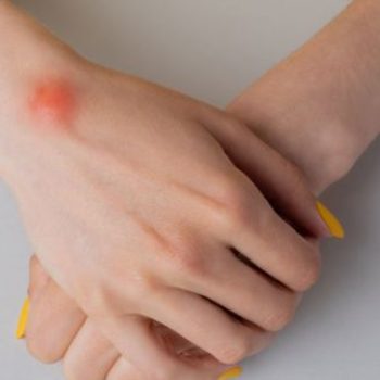 Lipoma Removal