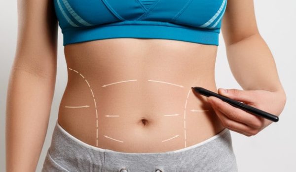 Liposuction 1