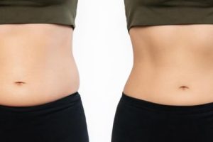 Liposuction (Before - After)