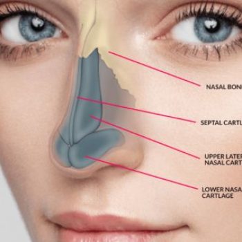 Rhinoplasty