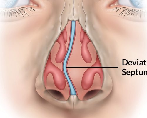 Septorhinoplasty