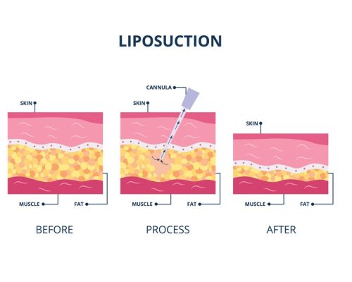 Suction Assisted Liposuction