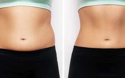 before after liposuction 1