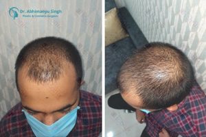 Hair Transplant (Before - After)