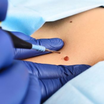 lipoma removal (1)