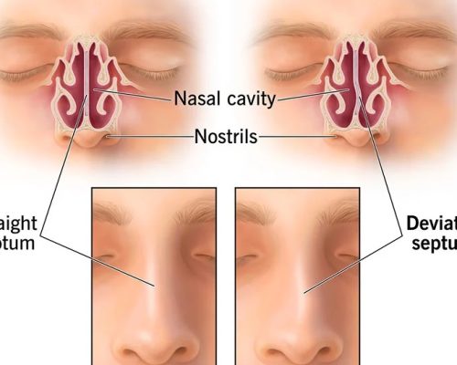 nose bone bend treatment