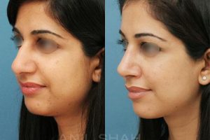 Rhinoplasty (Before - After)