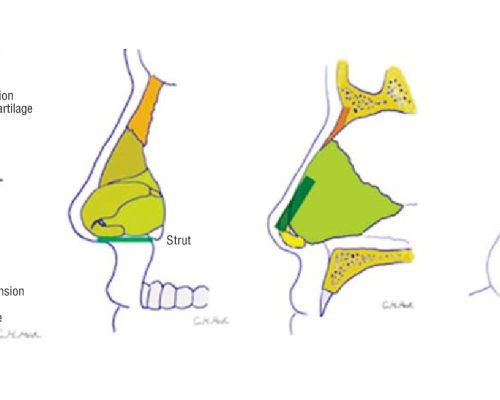 revision rhinoplasty